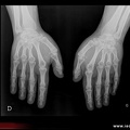 pseudohypoparathyroïdie: brachymétacarpie